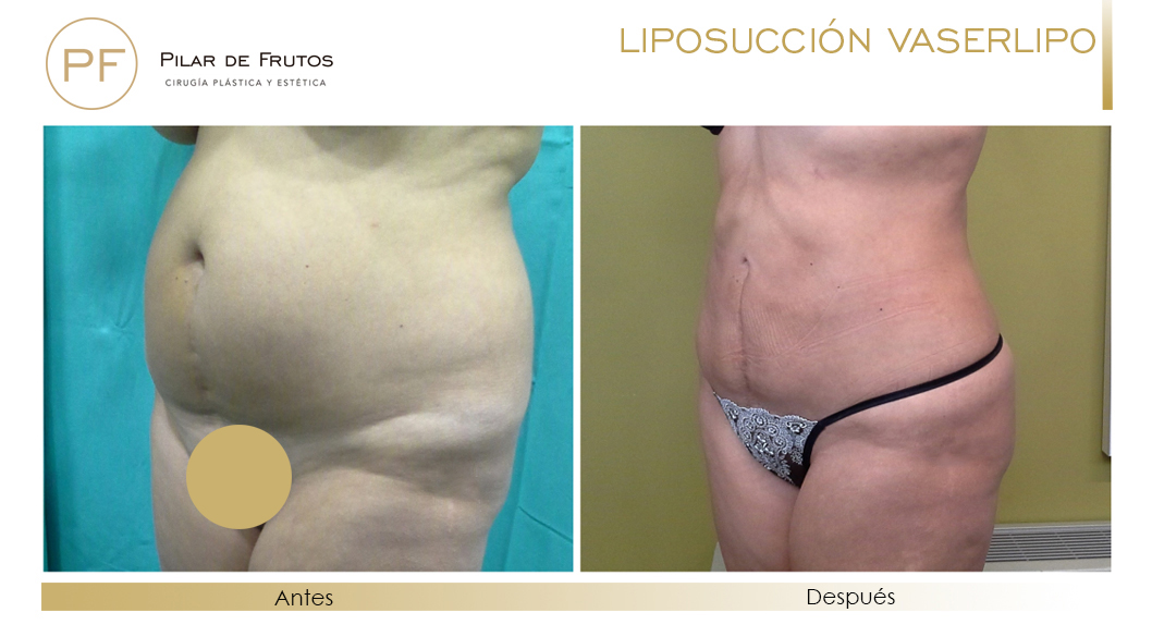 Fotos de Lipoescultura: antes y después - Pilar de Frutos