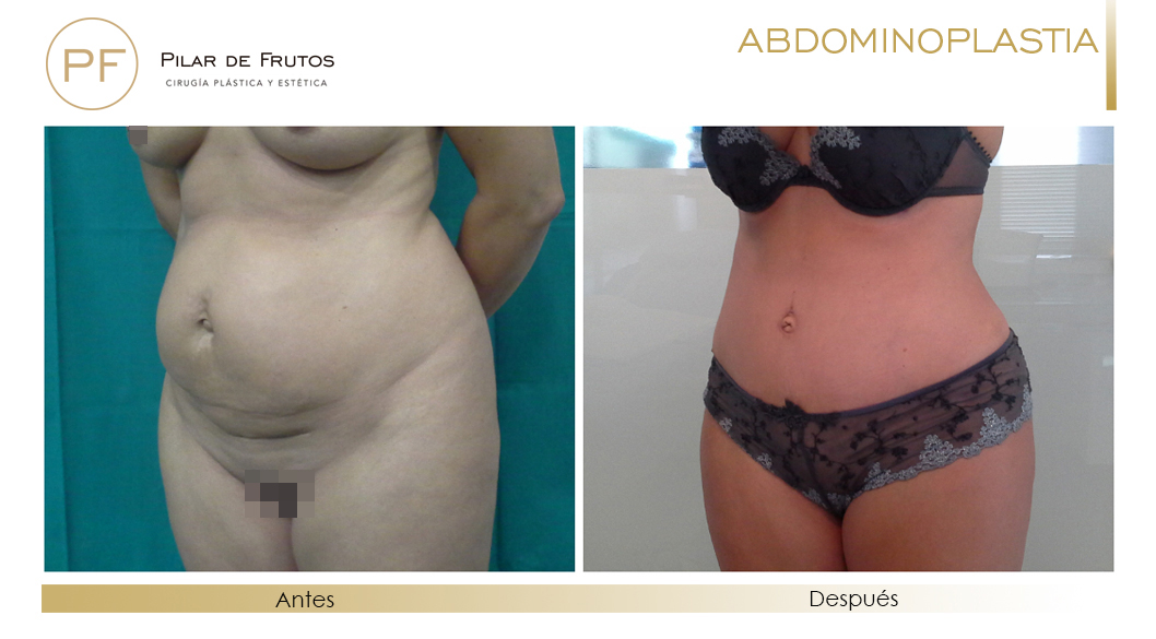Fotos de Abdominoplastia: antes y después - Pilar de Frutos